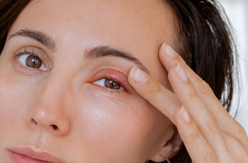 An image of a person rubbing a stye on their upper eyelid with visible swelling and redness showing.